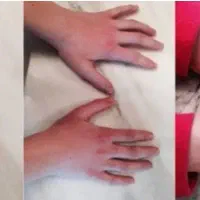 درمان پسوریازیس به صورت ریشه ای|آرایشی، بهداشتی، درمانی|جیرفت, |دیوار