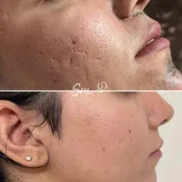 کربن تراپی (روشن سازی پوست کل بدن)