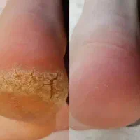 پدیکور درمانی همراه با زیبایی