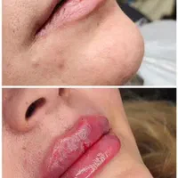 فیلر۶۰۰زیبایی صورت.لب با ژل/رفع چروک بابوتاکس۷۰۰|خدمات آرایشگری و زیبایی|برازجان, |دیوار