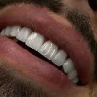 دندانپزشکی خیریه « ایمپلنت عصب کشی کامپوزیت لمینت|خدمات زیبایی و سلامت|قم, مصلاء|دیوار