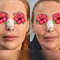 جشنواره تخفیف  بوتاکس و فیلر فقط به مدت ۱۰روز