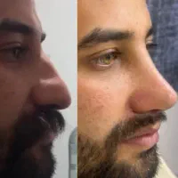 عمل جراحی بینی با کمترین قیمت در کشور