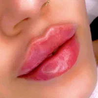 تزریق ژل 390پروفایلو،مادلینگ3900لیزر متدmتوسط پزشک|خدمات آرایشگری و زیبایی|تهران, صادقیه|دیوار