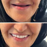 ساخت و تعمیر دندان مصنوعی/مواد آلمانی/نقد و اقساط