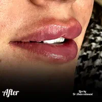 تزریق ژل ،بوتاکس،مزو توسط پزشک