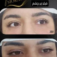 ژل بوتاکس خالبرداری|خدمات آرایشگری و زیبایی|زابل, |دیوار