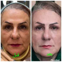 تنهامرکزلیفت صورت،بابیشترین تعدادنخاردارونخبدونخار|خدمات آرایشگری و زیبایی|مشهد, نیروی هوایی|دیوار