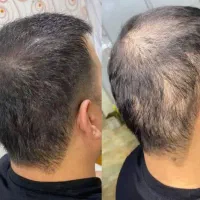 درمان قطعی ریزش مو و رویش مجدد