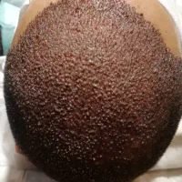 کاشت مو طبیعی ،ریش،ابرو