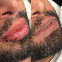 لک صورت بوتاکس خال موی سر ریش|خدمات آرایشگری و زیبایی|اهواز, کیان اباد|دیوار