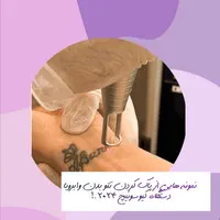 پاک کردن  وریموتاتو بدن و ابرو با لیزر کیوسوئیچ|خدمات آرایشگری و زیبایی|اصفهان, نقش جهان|دیوار
