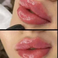 اف 10درصدی ژل و بوتاکس