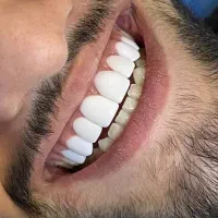 کامپوزیت دندان بابل|خدمات آرایشگری و زیبایی|امیرکلا, |دیوار