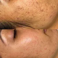 حذف لک و کک و مک و جای جوش صورت آقایان و بانوان