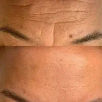 کرم لیفت و ضد چروک صورت جوانسازی پوست