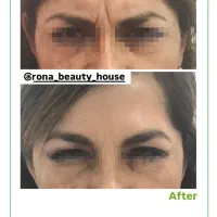 تخفیف ویژه بوتاکس فیلر فیشال لیزر فیشیال ژل|خدمات آرایشگری و زیبایی|فردیس, شهرک ۱۱۰|دیوار