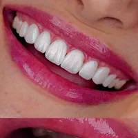 کامپوزیت فیسینگ ارتودنسی بزرگسالان و کودکان بیهوشی|خدمات آرایشگری و زیبایی|شیراز, زرگری|دیوار
