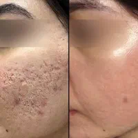 فیشیال پاکسازی خانمها و آقایان در مطب