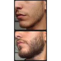 پرپشتی ریش بدون کاشت و خون ریزی|آرایشی، بهداشتی، درمانی|مرودشت, بیست متری بیمارستان|دیوار