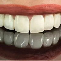 ونیر کامپوزیت ژاپنی اصل (تعرفه دولتی + اقساط)