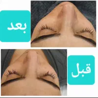 فیشال پوست با مواد ودستگاه