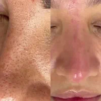 پاکسازی پوست به همراه دستگاه شروع قیمت از 280|خدمات آرایشگری و زیبایی|شیراز, کاراندیش|دیوار