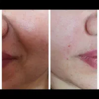 انجام ژل و بوتاکس با بهترین مواد اقساطی|خدمات آرایشگری و زیبایی|آزادشهر, |دیوار