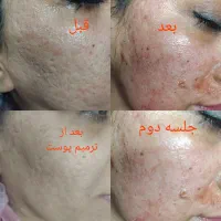 پلکسر پلاسما خالبرداری مزونیدلینگ مزو آموزش|خدمات آرایشگری و زیبایی|زاهدان, |دیوار