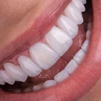 کامپوزیت، لمینت، ایمپلنت دندان اقسا*طی