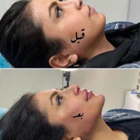 جشنواره  تزریق چربی لیزر لاغری ژل بوتاکس|خدمات آرایشگری و زیبایی|تهران, هفت حوض|دیوار