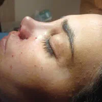 تخفیف ویژه عمل بینی فقط فقط۳۵
