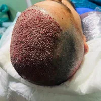 کاشت تخصصی مو سوپرمیکروگرفت با شرایط ویژه|خدمات آرایشگری و زیبایی|اردبیل, |دیوار