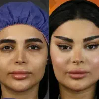 تخفیف ژل بوتاکس نخ کاشت ابرو