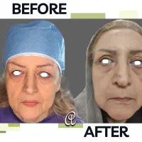 جشنواره بلفاروپلاستی جراحی پلک با بخیه لیزری|خدمات آرایشگری و زیبایی|تهران, شهرک غرب|دیوار