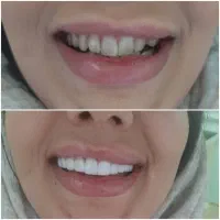 کامپوزیت دندان فقط ۷ میلیون در تهران|خدمات آرایشگری و زیبایی|قم, سالاریه|دیوار