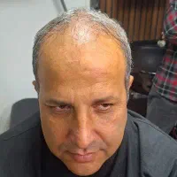 کاشت مو و ابرو و مراقبت های بعد از کاشت