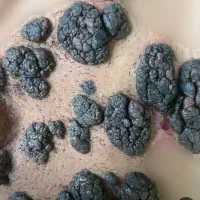 رفع ریشه ای زگیل در کمتر از 2هفته