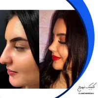 تخفیف فوق العاده عمل بینی