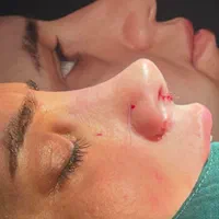 عمل جراحی بینی با تخفیف ویژه در فستیوال تابستانه|خدمات آرایشگری و زیبایی|تهران, فلسطین (میدان انقلاب)|دیوار