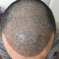 کاشت مو تخصصی دلربا شیراز|خدمات آرایشگری و زیبایی|بوشهر, |دیوار