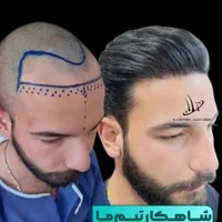 کاشت شیرازی موی سر و ابرو در ارومیه به مدت کوتاه|خدمات آرایشگری و زیبایی|ارومیه, |دیوار