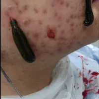 انواع حجامت، زالودرمانی، بادکش، کایروپراکتیک