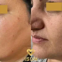 پلاژن درمانی