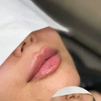 آموزش و تزریق ژل بوتاکس پی ار پی پی ار اف اگزوزوم|خدمات آرایشگری و زیبایی|اهواز, کیانپارس |دیوار