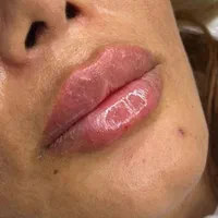 بوتاکس،ژل لب روسی،لیزر|خدمات آرایشگری و زیبایی|اسلام‌شهر, شهرک واوان|دیوار
