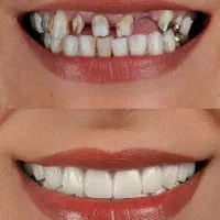 ایمپلنت و روکش اقساطی دندانپزشکی در خرم آباد|خدمات آرایشگری و زیبایی|اندیمشک, |دیوار
