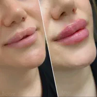 ژل بوتاکس کانتورینگ صورت آنزیم فیلر بینی مزوژل|خدمات آرایشگری و زیبایی|گرمسار, |دیوار