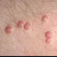 لیزر زگیل تناسلی و خالبرداری در ایلام