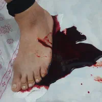 ماساژ،دیسک سیاتیک رگ گیری حجامت فصد طب سنتی